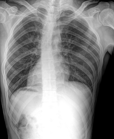 拍胸片需要脱掉衣服吗