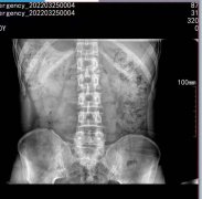 5kw移动式x光机能拍腰椎吗？