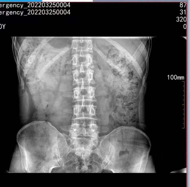X光机腰椎效果图