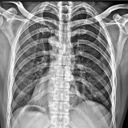 移动DR拍片效果