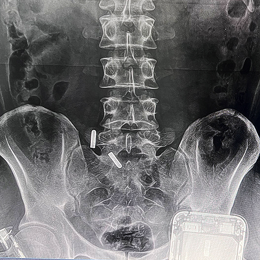 河北骨科诊所便携DR拍摄效果图