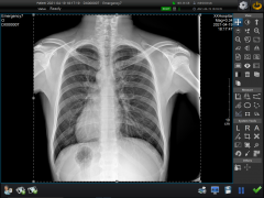 X光摄片当中有哪些伪影的类型