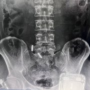 哪些因素可以影响x射线图像的质量