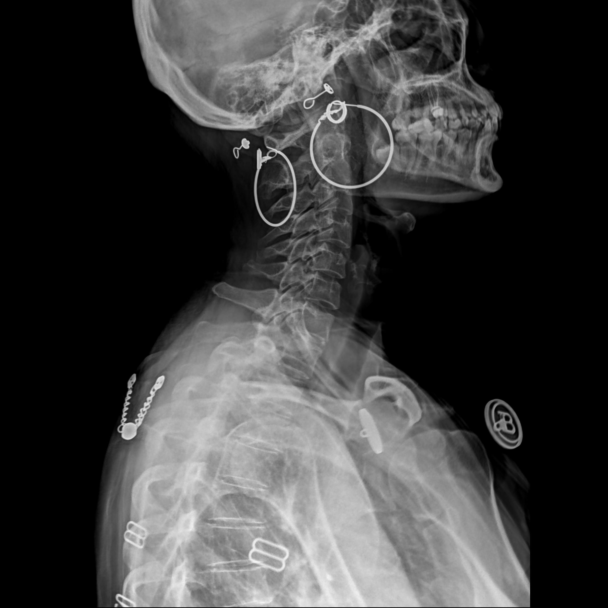 移动X光机拍片效果图