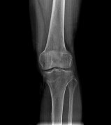 X光越强,拍出来的越亮还是越暗