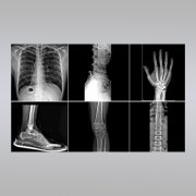 传统X射线与数字X射线的优缺点