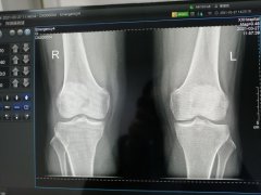 X光机欠曝和过曝的表现