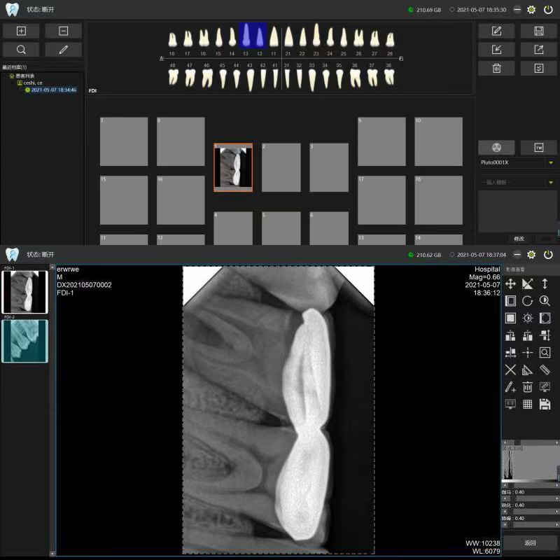牙科传感器拍片效果图