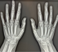 如何根据被摄物体的大小调整X线摄影距离？