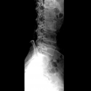 X线片有哪些伪影